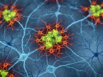A new study found that the sleep loss in Alzheimer’s is not caused by plaques. It is caused by the brain’s own immune response to them, and researchers found a way to reverse it
