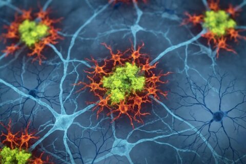 A new study found that the sleep loss in Alzheimer’s is not caused by plaques. It is caused by the brain’s own immune response to them, and researchers found a way to reverse it
