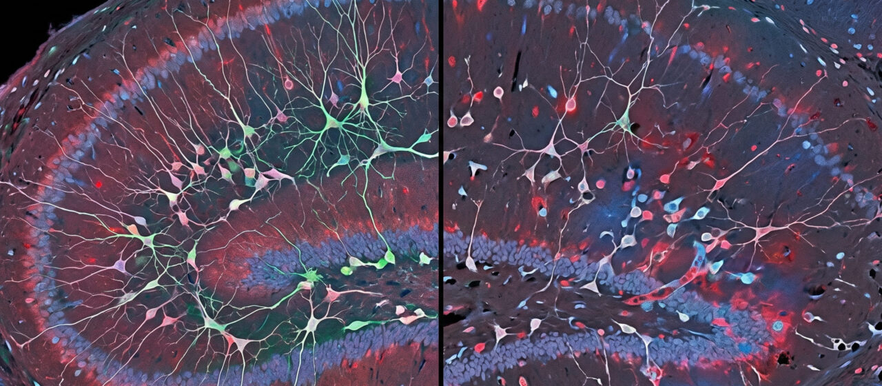 Depression does not just change how you feel. A study of 495,000 brain cells found it physically disrupts the brain’s ability to create new neurons in the region responsible for emotional memory.
