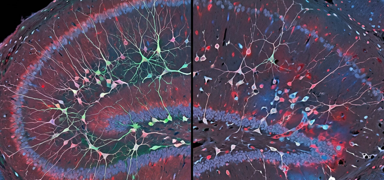 Depression does not just change how you feel. A study of 495,000 brain cells found it physically disrupts the brain’s ability to create new neurons in the region responsible for emotional memory.