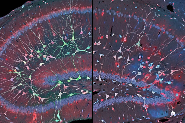 Depression does not just change how you feel. A study of 495,000 brain cells found it physically disrupts the brain’s ability to create new neurons in the region responsible for emotional memory.